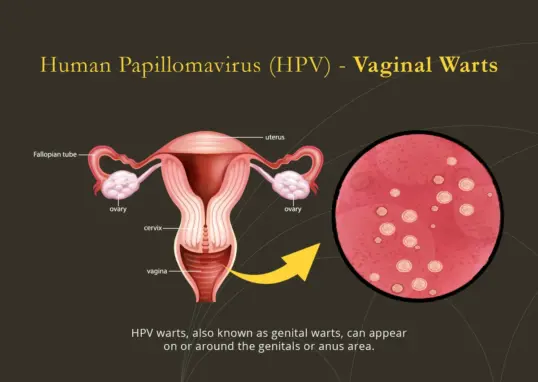 hpv — IN news