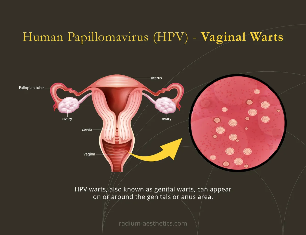 hpv — IN news